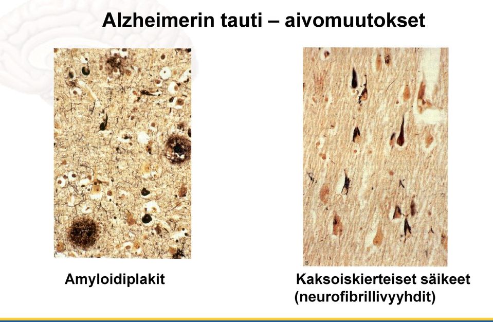 Amyloidiplakit