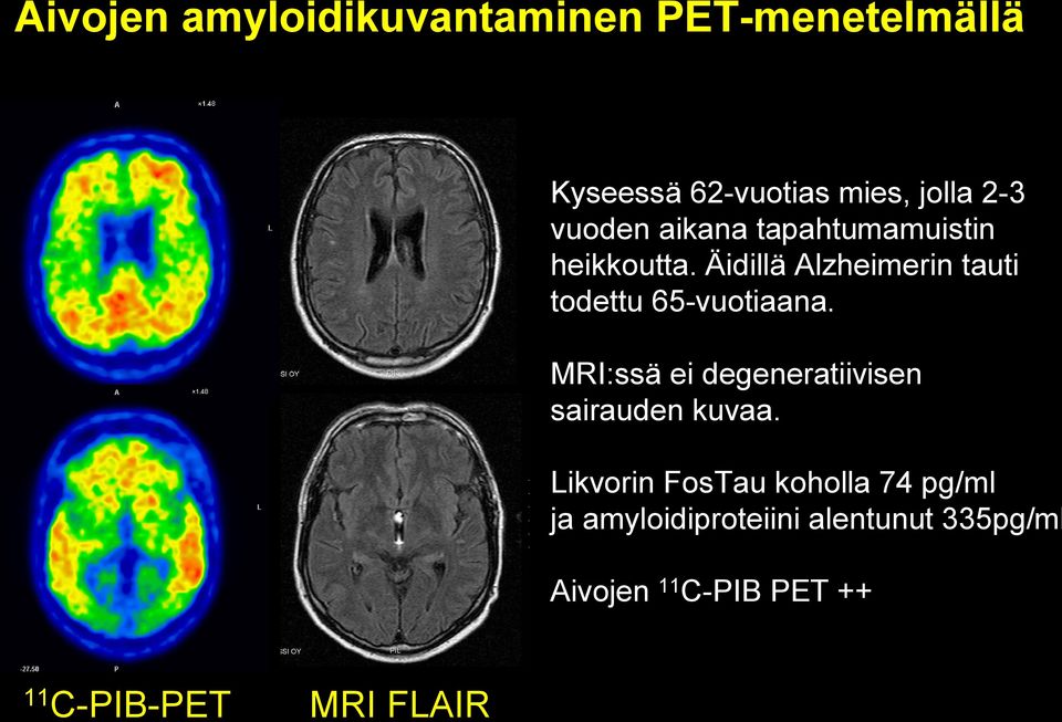 Äidillä Alzheimerin tauti todettu 65-vuotiaana.