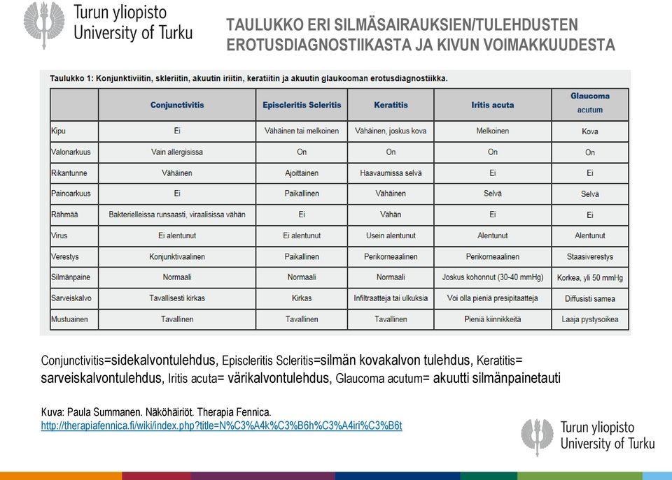 sarveiskalvontulehdus, Iritis acuta= värikalvontulehdus, Glaucoma acutum= akuutti silmänpainetauti