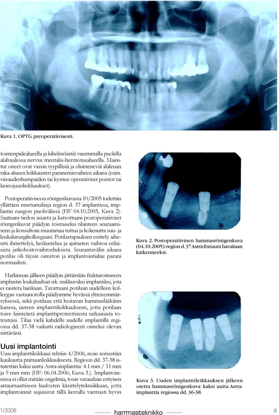Postoperatiivisessa röntgenkuvassa 10/2005 todettiin yllättäen murtumalinja region d. 37 implantissa, implantin rungon puolivälissä (HF 04.10.2005, Kuva 2).