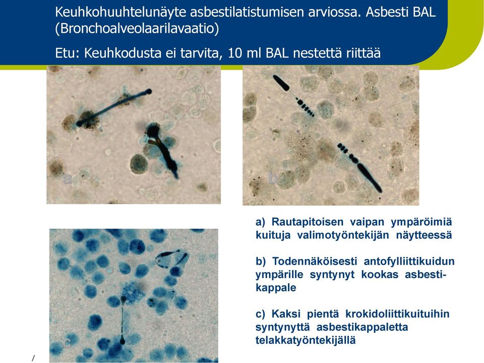 10 ml BAL nestettä riittää a b a) Rautapitoisen vaipan ympäröimiä kuituja valimotyöntekijän näytteessä b)