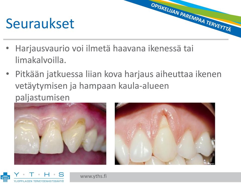 Pitkään jatkuessa liian kova harjaus