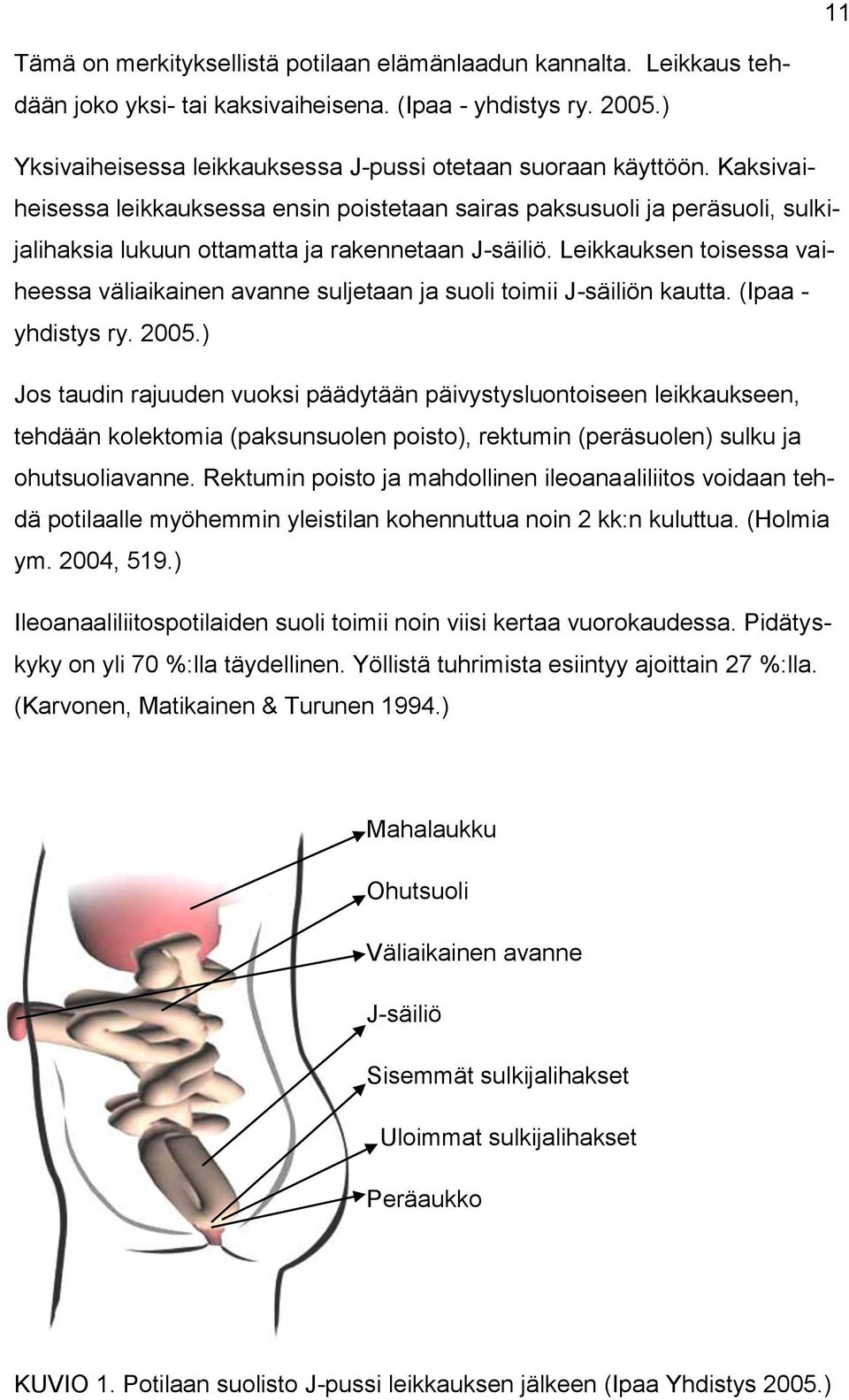 Leikkauksen toisessa vaiheessa väliaikainen avanne suljetaan ja suoli toimii J-säiliön kautta. (Ipaa - yhdistys ry. 2005.