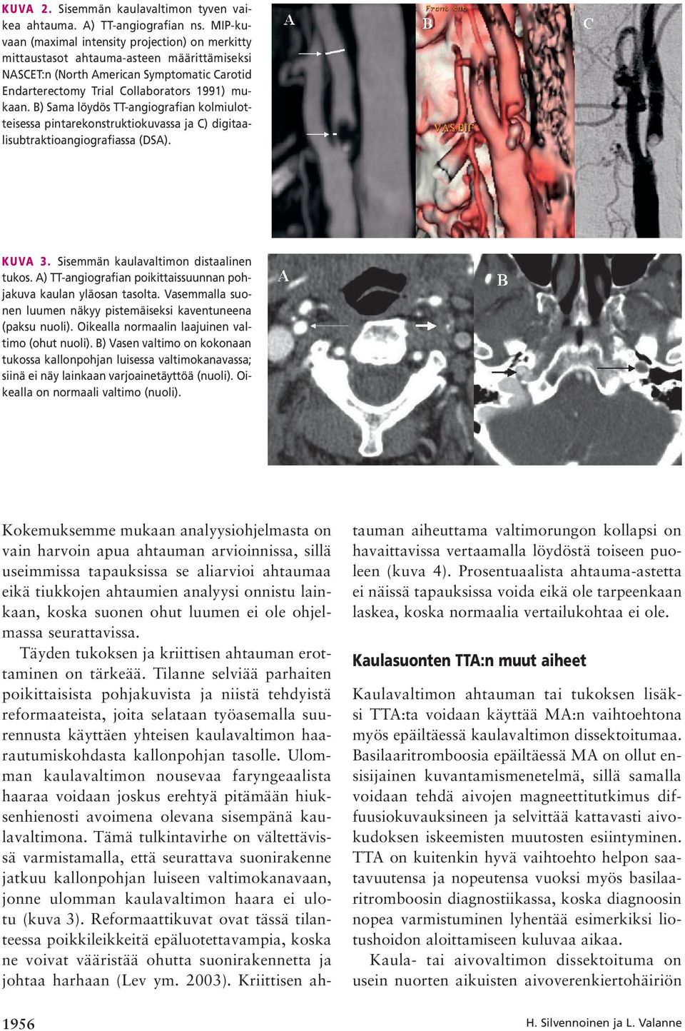 B) Sama löydös TT-angiografian kolmiulotteisessa pintarekonstruktiokuvassa ja C) digitaalisubtraktioangiografiassa (DSA). KUVA 3. Sisemmän kaulavaltimon distaalinen tukos.