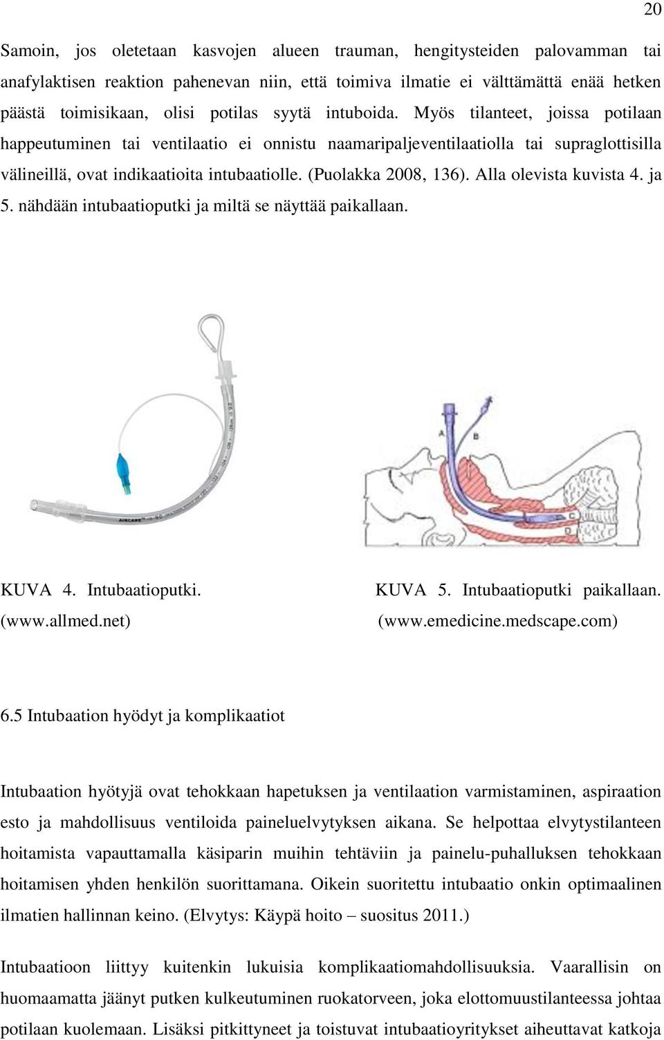 (Puolakka 2008, 136). Alla olevista kuvista 4. ja 5. nähdään intubaatioputki ja miltä se näyttää paikallaan. KUVA 4. Intubaatioputki. (www.allmed.net) KUVA 5. Intubaatioputki paikallaan. (www.emedicine.