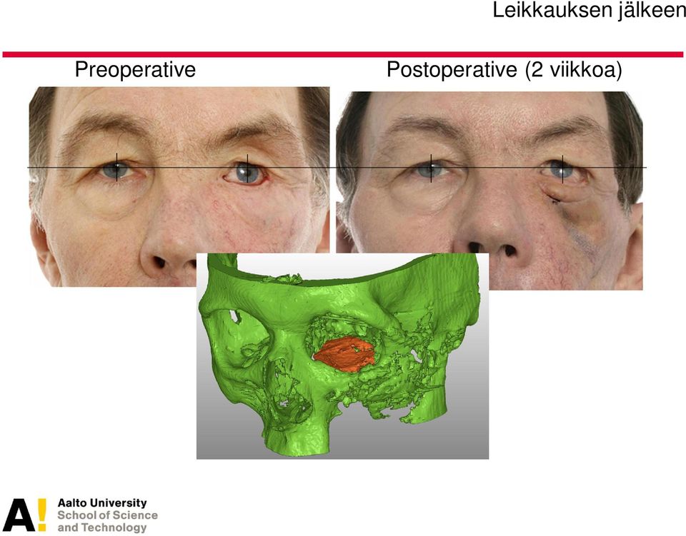 Preoperative