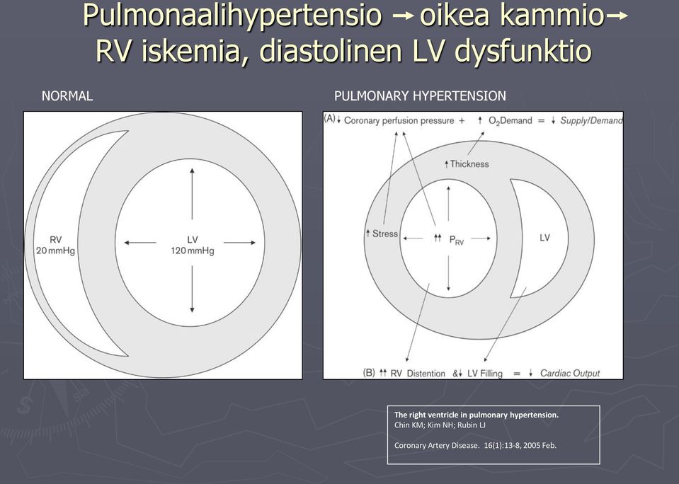 The right ventricle in pulmonary hypertension.