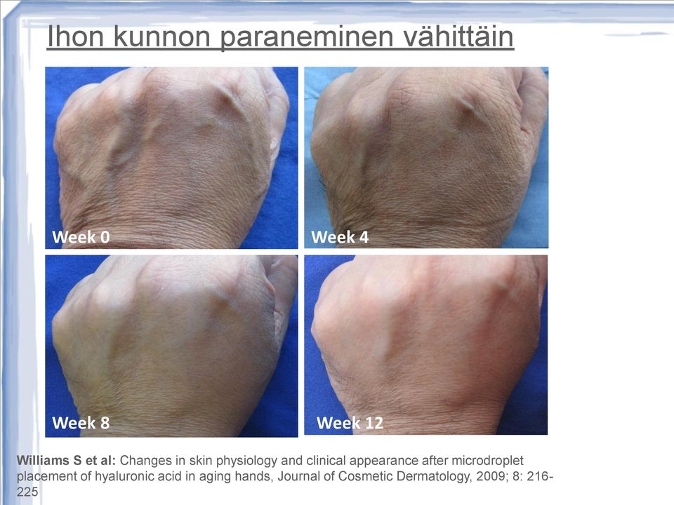 appearance after microdroplet placement of hyaluronic acid in