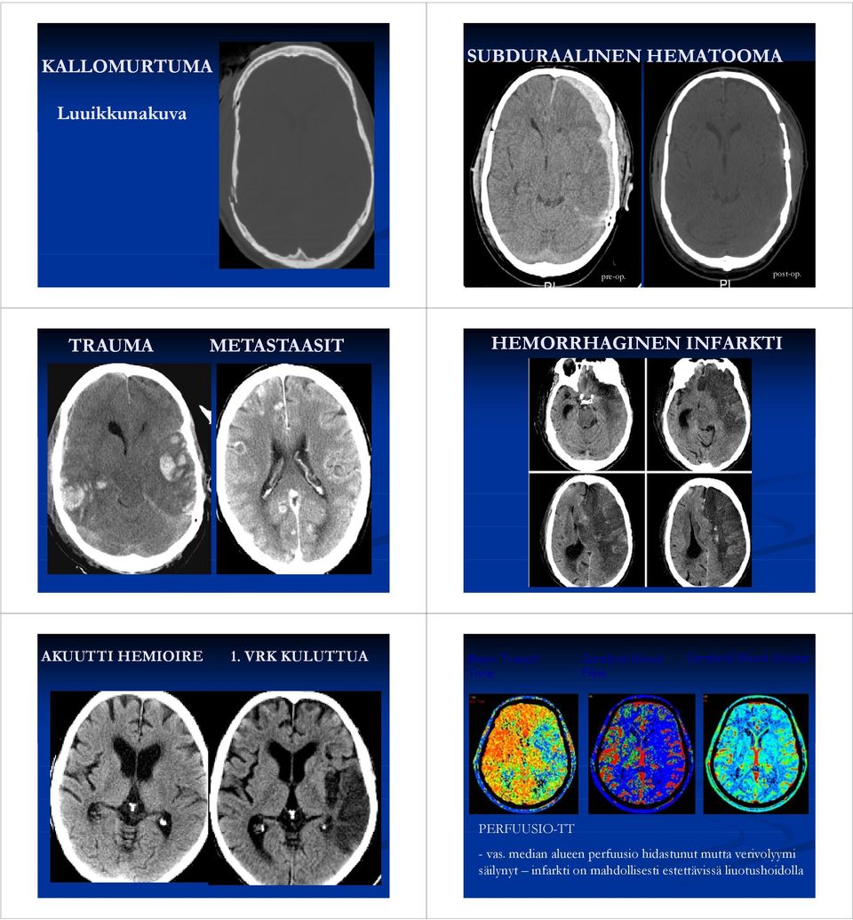 VRK KULUTTUA Mean Transit Cerebral Blood Cerebral Blood Volume Time Flow