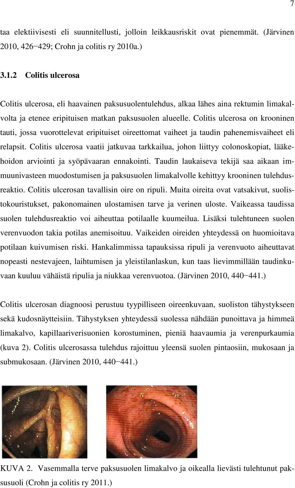 Colitis ulcerosa on krooninen tauti, jossa vuorottelevat eripituiset oireettomat vaiheet ja taudin pahenemisvaiheet eli relapsit.