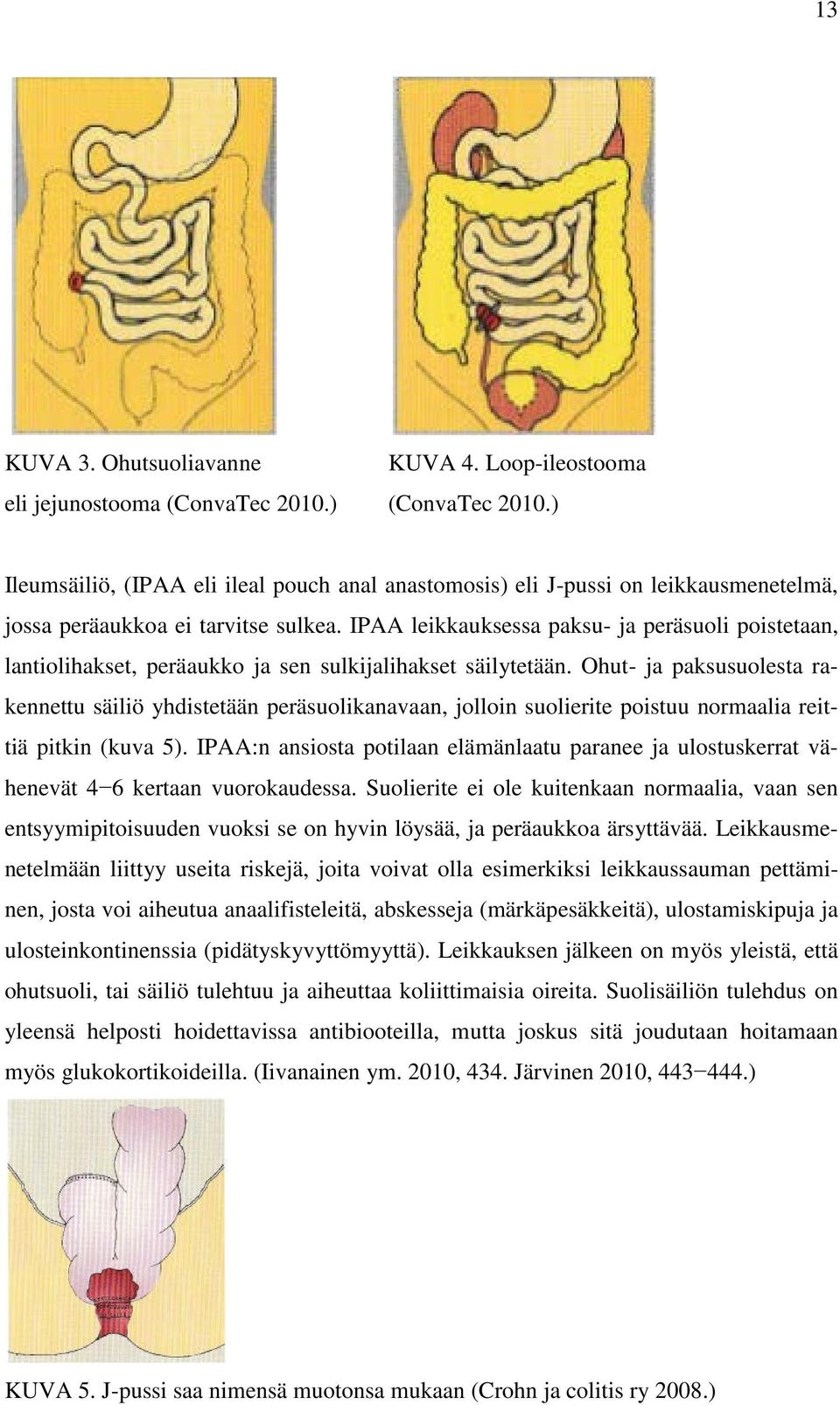 IPAA leikkauksessa paksu- ja peräsuoli poistetaan, lantiolihakset, peräaukko ja sen sulkijalihakset säilytetään.