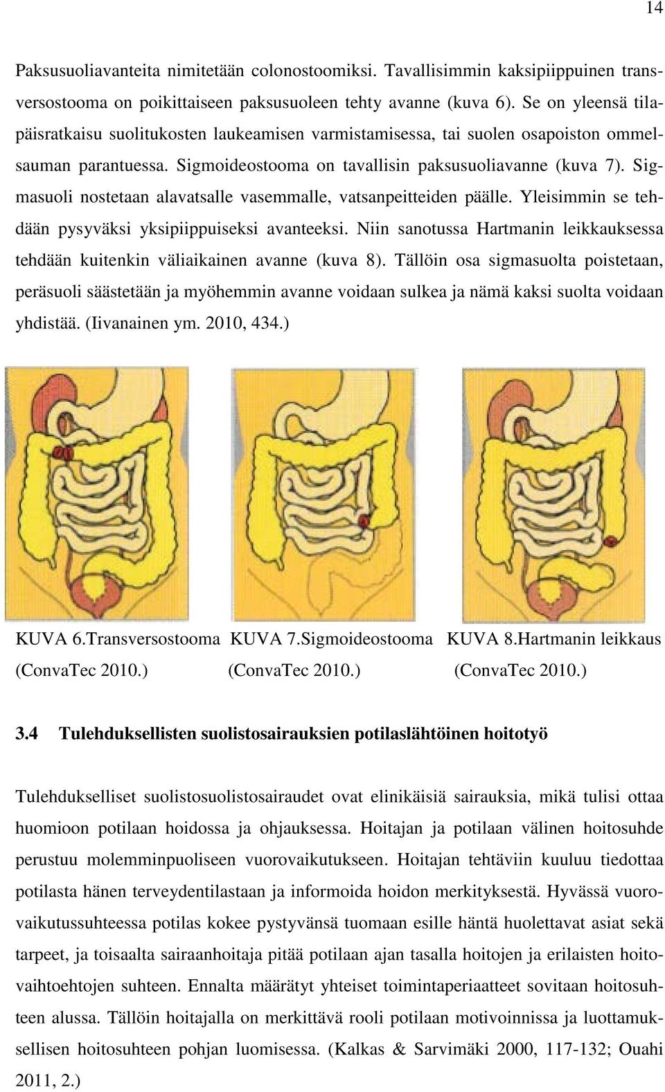 Sigmasuoli nostetaan alavatsalle vasemmalle, vatsanpeitteiden päälle. Yleisimmin se tehdään pysyväksi yksipiippuiseksi avanteeksi.