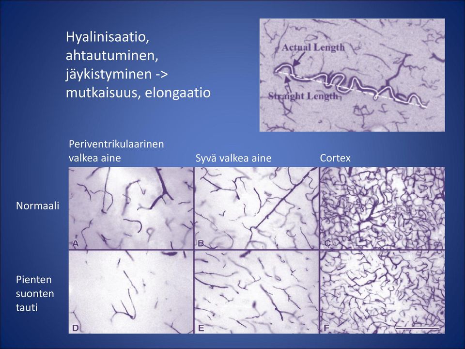 elongaatio Periventrikulaarinen valkea