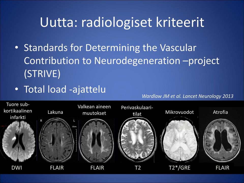 subkortikaalinen infarkti Lakuna Valkean aineen muutokset Wardlaw JM et al.