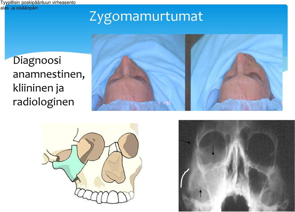 sisäänpäin Zygomamurtumat