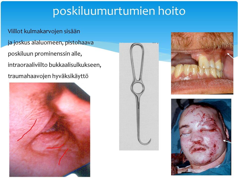 pistohaava poskiluun prominenssinalle,