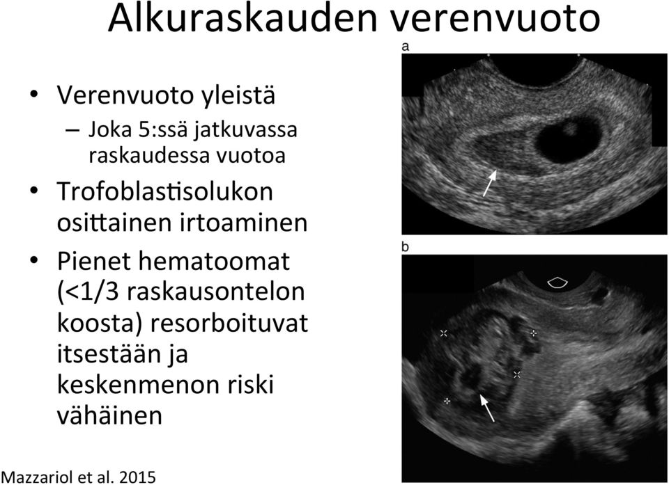 irtoaminen Pienet hematoomat (<1/3 raskausontelon koosta)