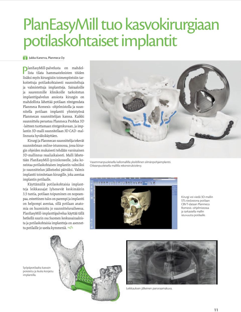 Sairaaloille ja suuremmille klinikoille tarkoitetun implanttipalvelun ansiosta kirurgin on mahdollista lähettää potilaan röntgendata Planmeca Romexis -ohjelmistolla ja suunnitella potilaan implantti