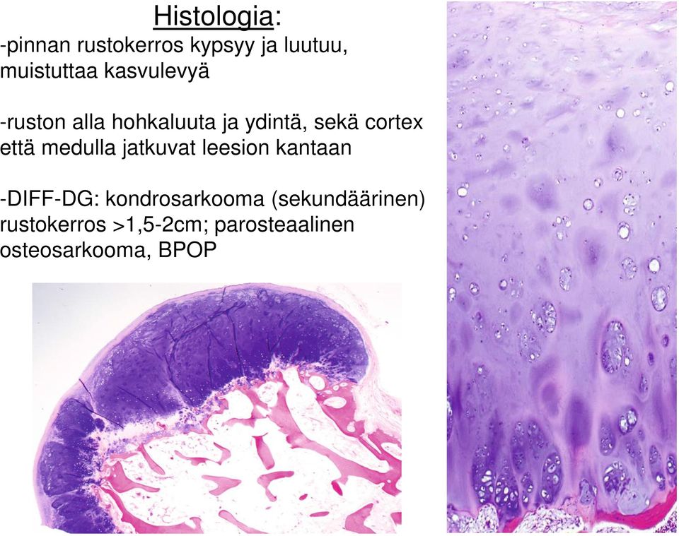 medulla jatkuvat leesion kantaan -DIFF-DG: kondrosarkooma