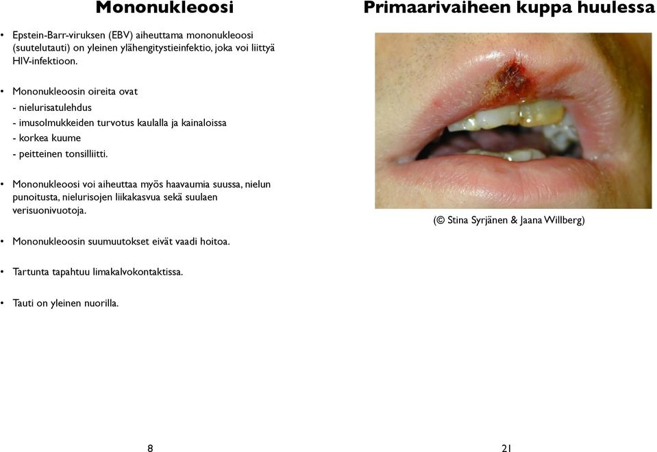 Mononukleoosin oireita ovat - nielurisatulehdus - imusolmukkeiden turvotus kaulalla ja kainaloissa - korkea kuume - peitteinen tonsilliitti.