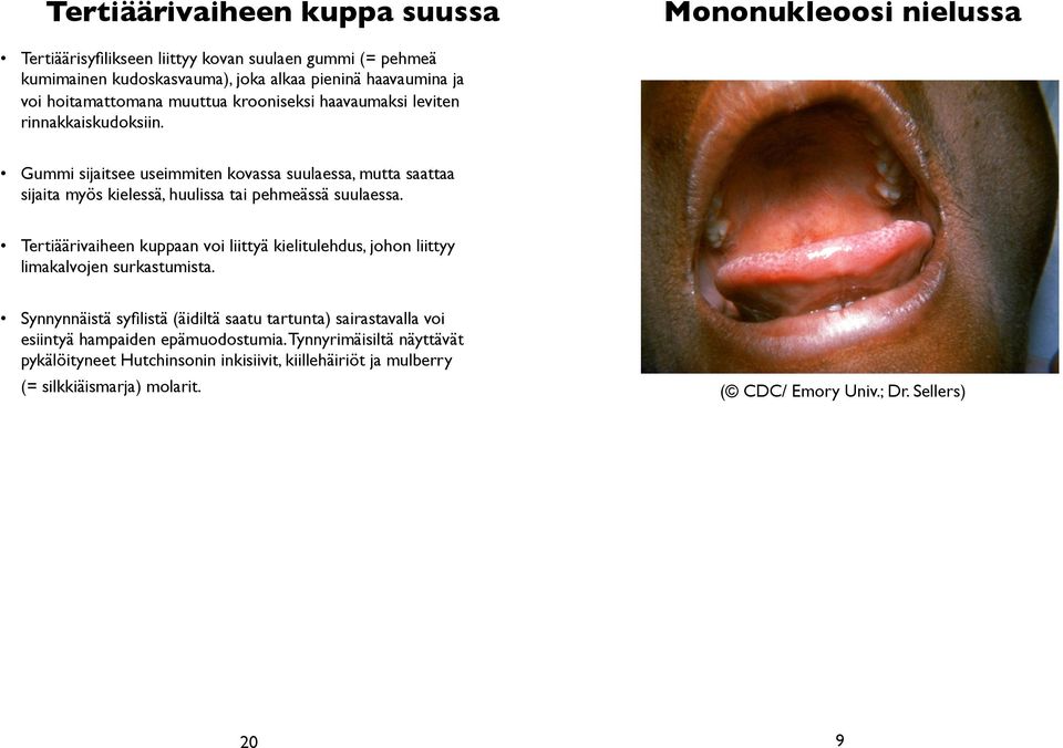 Gummi sijaitsee useimmiten kovassa suulaessa, mutta saattaa sijaita myös kielessä, huulissa tai pehmeässä suulaessa.