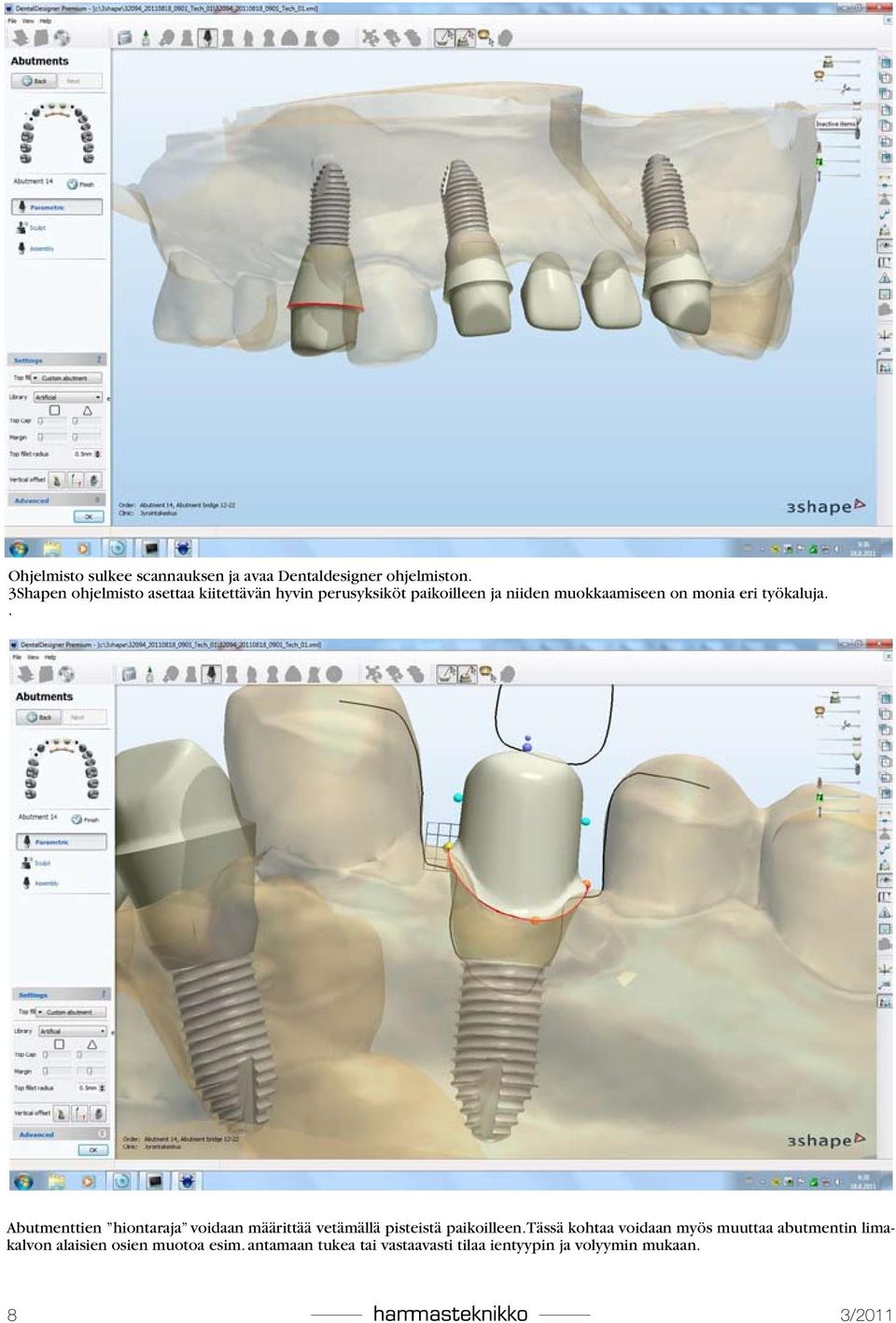 eri työkaluja.. Abutmenttien hiontaraja voidaan määrittää vetämällä pisteistä paikoilleen.