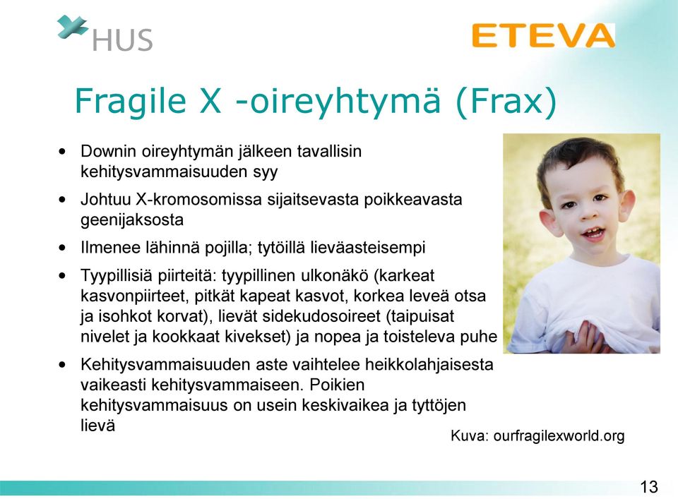 kasvot, korkea leveä otsa ja isohkot korvat), lievät sidekudosoireet (taipuisat nivelet ja kookkaat kivekset) ja nopea ja toisteleva puhe