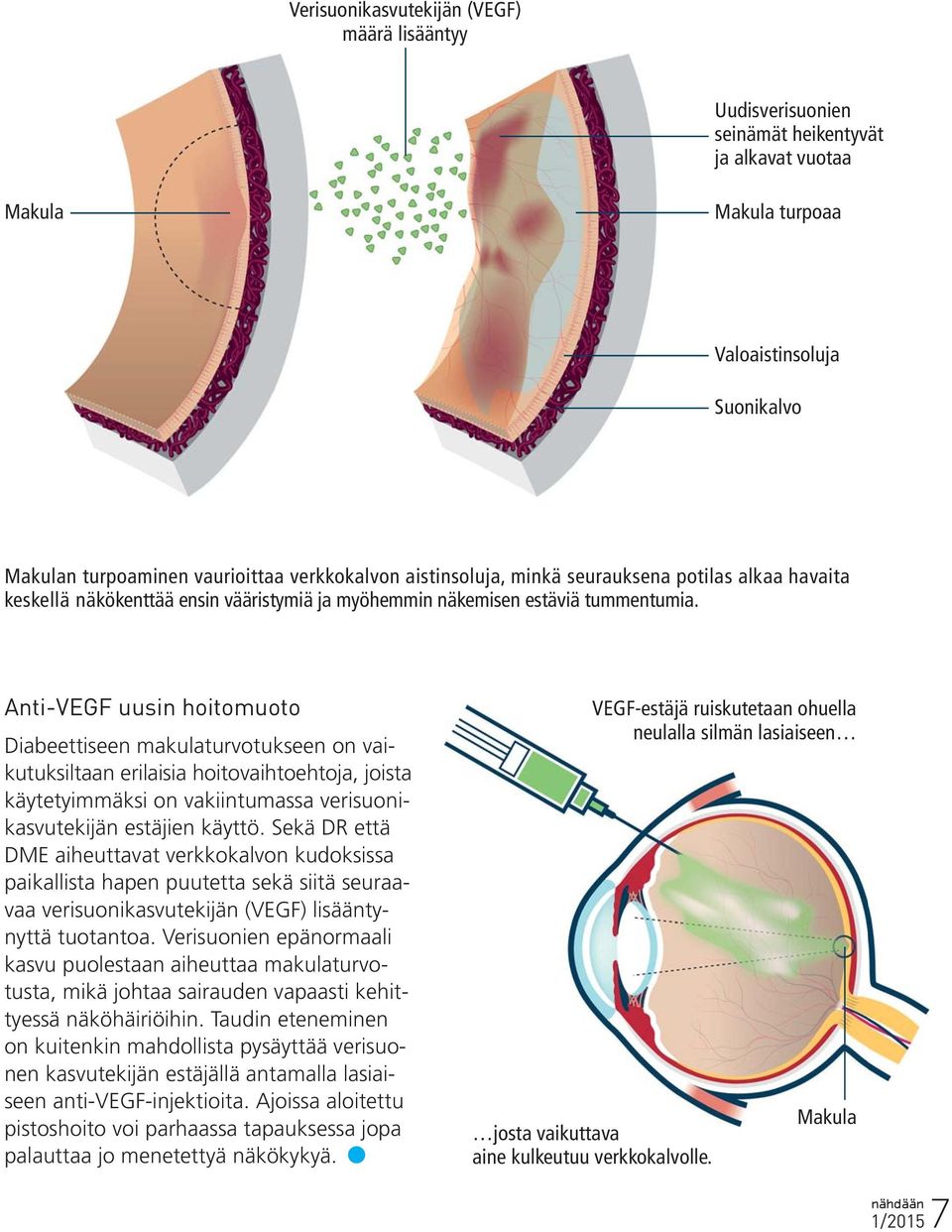 Anti-VEGF uusin hoitomuoto Diabeettiseen makulaturvotukseen on vaikutuksiltaan erilaisia hoitovaihtoehtoja, joista käytetyimmäksi on vakiintumassa verisuonikasvutekijän estäjien käyttö.