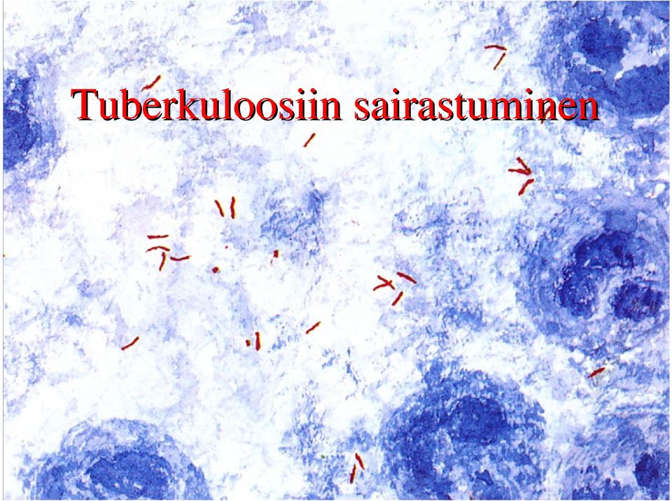 tuberkuloosin hoito