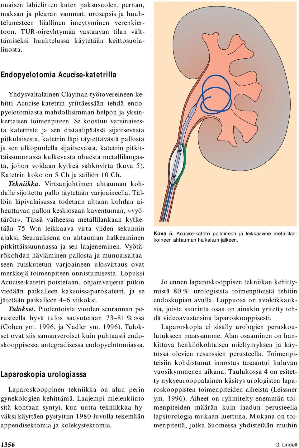 Endopyelotomia Acucise-katetrilla Yhdysvaltalainen Clayman työtovereineen kehitti Acucise-katetrin yrittäessään tehdä endopyelotomiasta mahdollisimman helpon ja yksinkertaisen toimenpiteen.