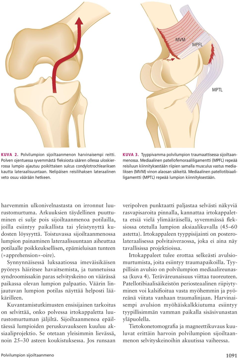 Nelipäisen reisilihaksen lateraalinen veto osuu väärään hetkeen. Kuva 3. Tyyppivamma polvilumpion traumaattisessa sijoiltaanmenossa.