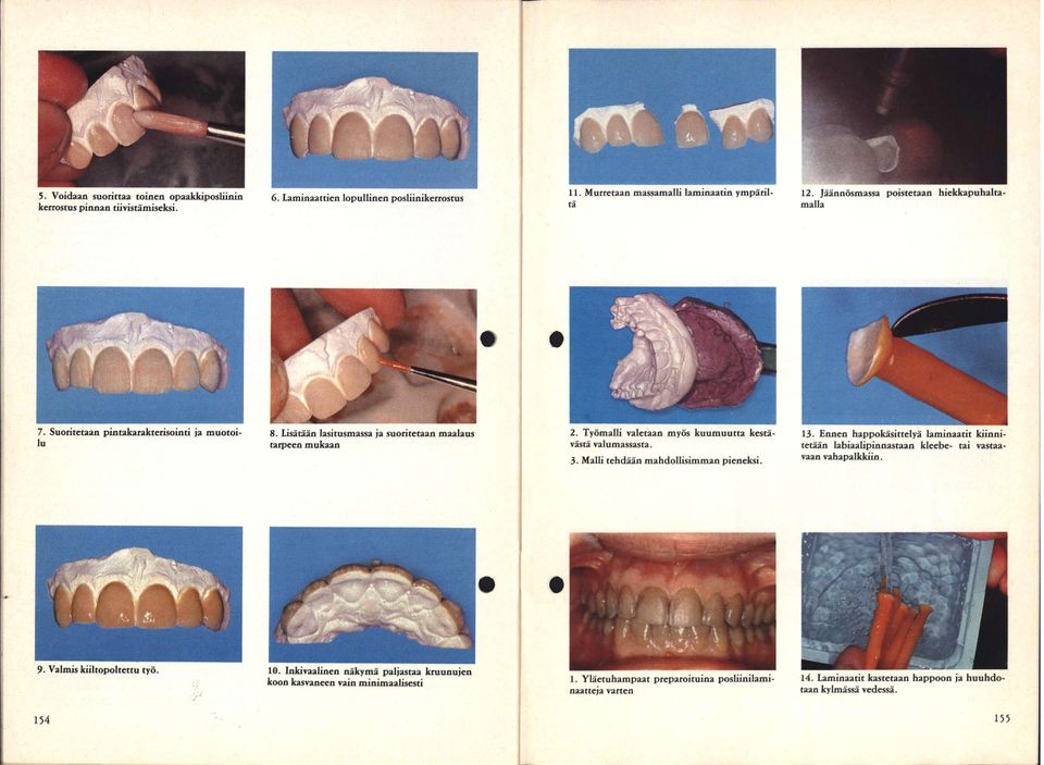 Työmalli valetaan myös kuumuutta kestä- 13. Ennen happokäsittelyä laminaatit kiinnivästä valumassasta. tetään labiaalipinnastaan kleebe- tai vastaa- 3. Malli tehdään mahdollisimman pieneksi.