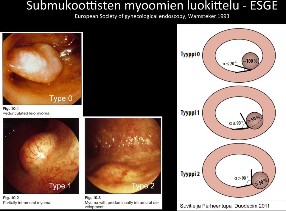 endoscopy, Wamsteker 1993 Type 0 Type 1