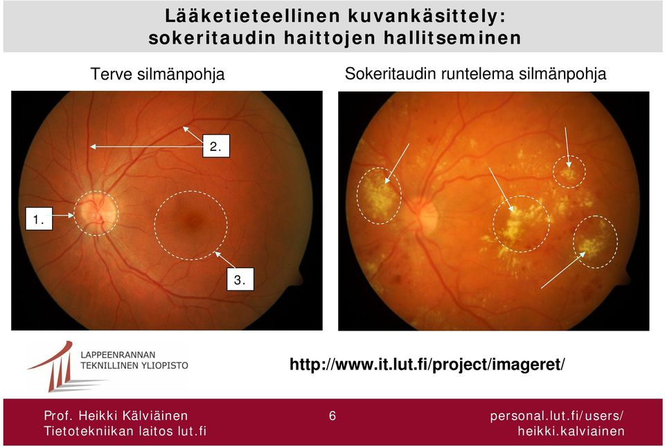 silmänpohja Sokeritaudin runtelema