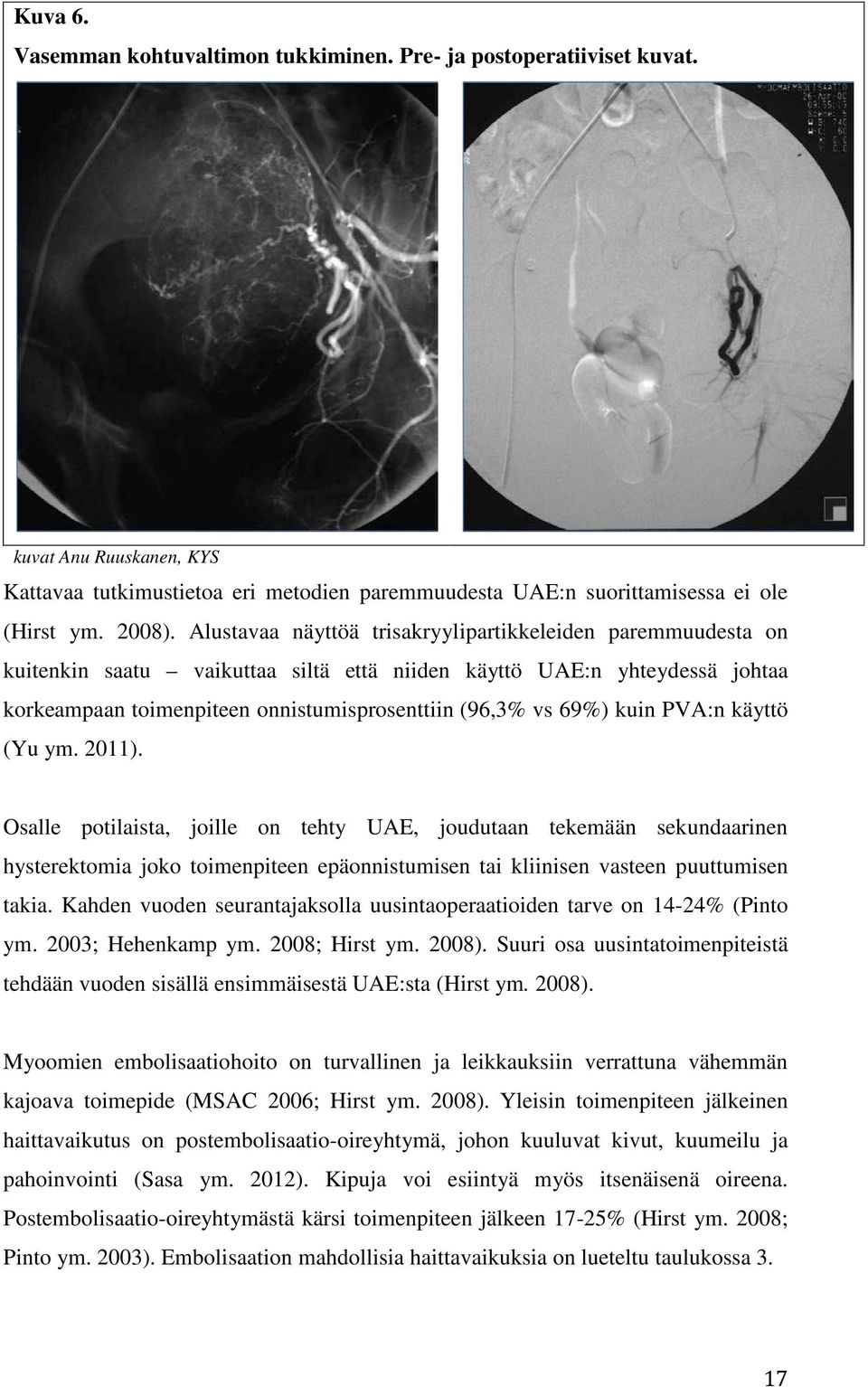 kuin PVA:n käyttö (Yu ym. 2011). Osalle potilaista, joille on tehty UAE, joudutaan tekemään sekundaarinen hysterektomia joko toimenpiteen epäonnistumisen tai kliinisen vasteen puuttumisen takia.