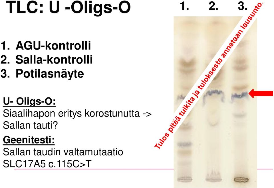 Potilasnäyte U- Oligs-O: Siaalihapon eritys