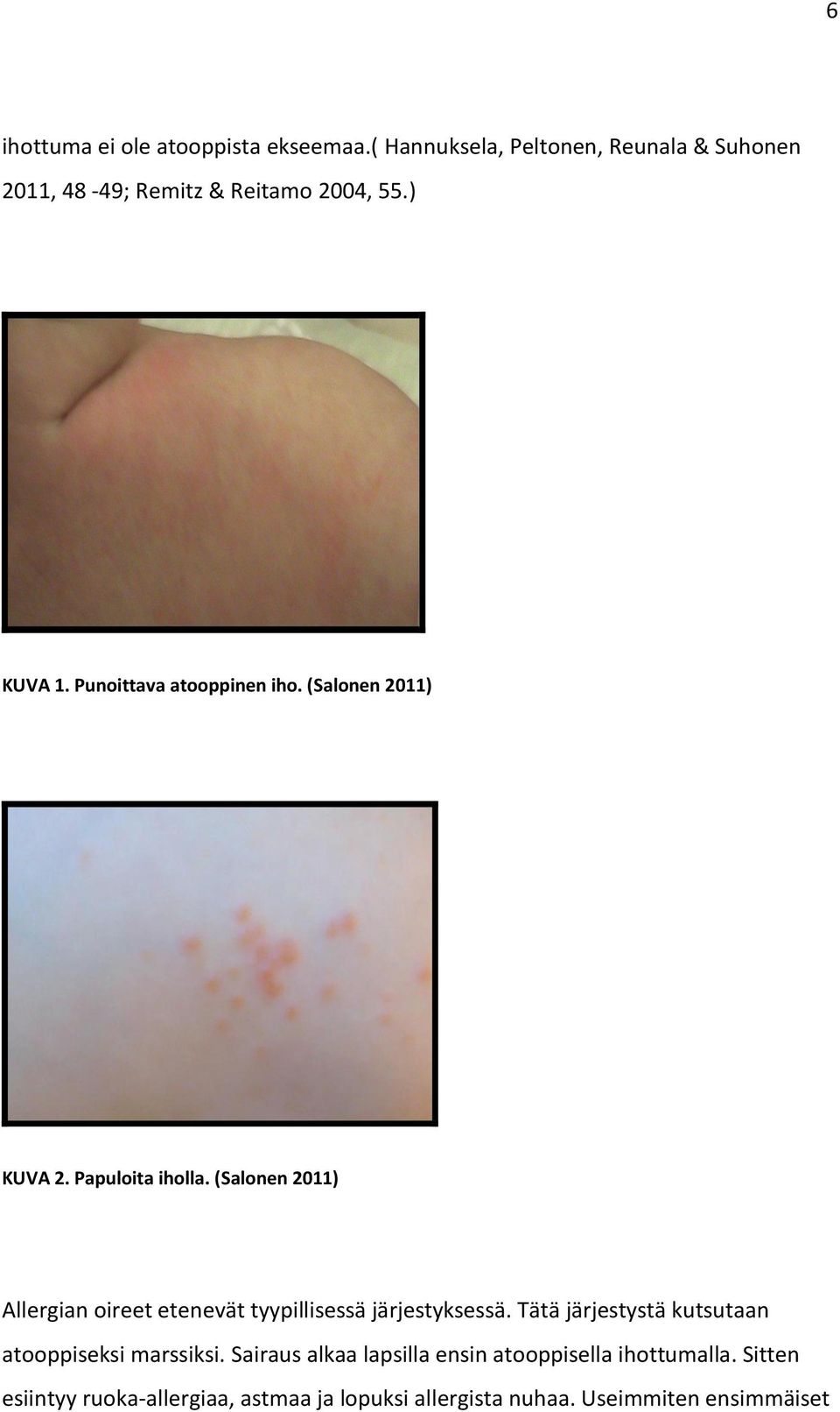 (Salonen 2011) KUVA 2. Papuloita iholla. (Salonen 2011) Allergian oireet etenevät tyypillisessä järjestyksessä.