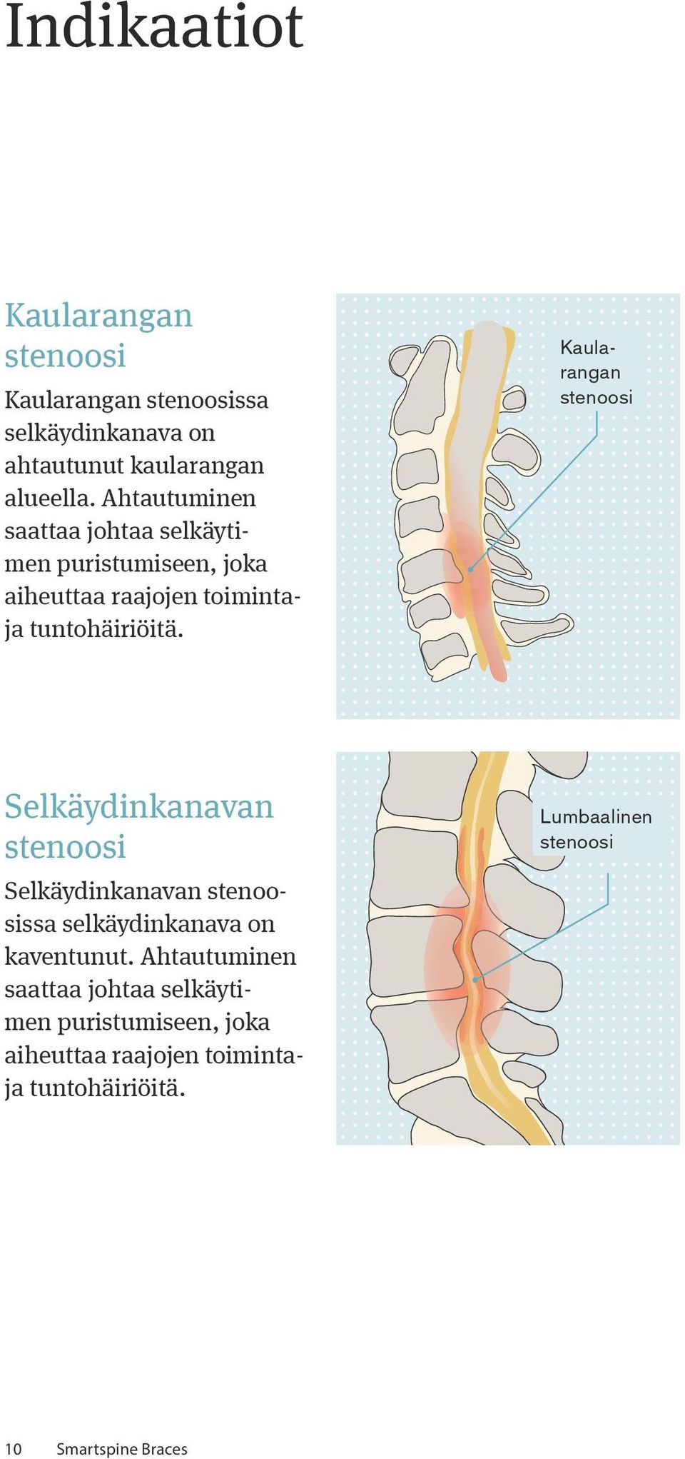 Kaularangan stenoosi Selkäydinkanavan stenoosi Selkäydinkanavan stenoosissa selkäydinkanava on kaventunut.