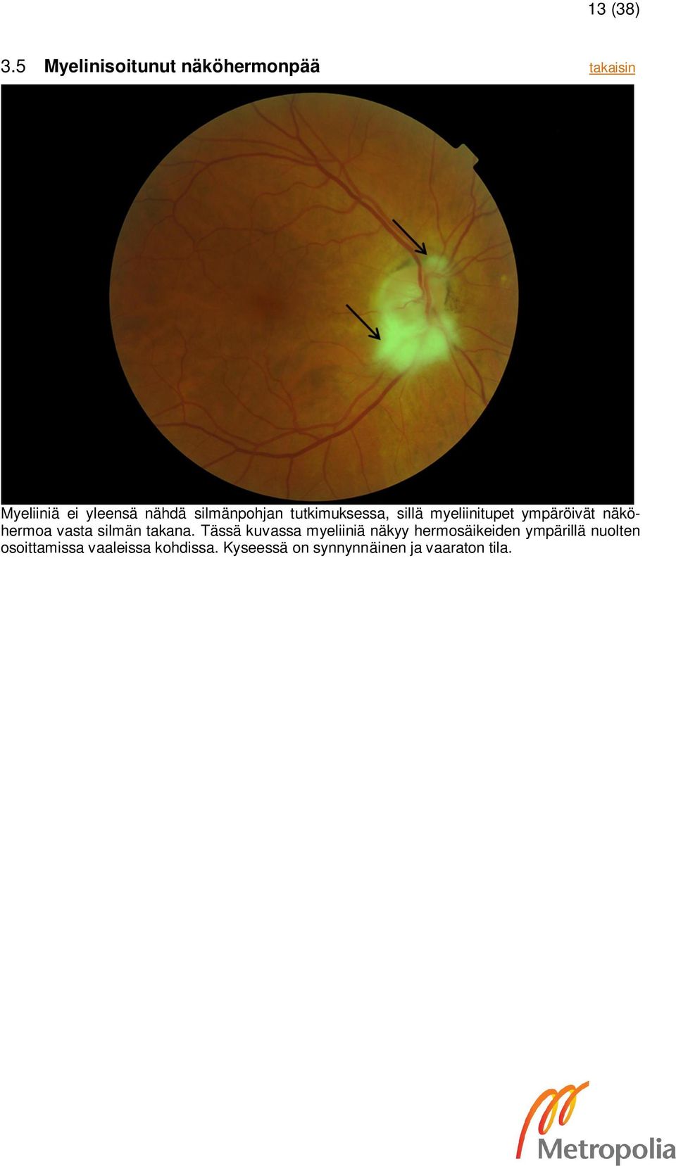 silmänpohjan tutkimuksessa, sillä myeliinitupet ympäröivät näköhermoa vasta