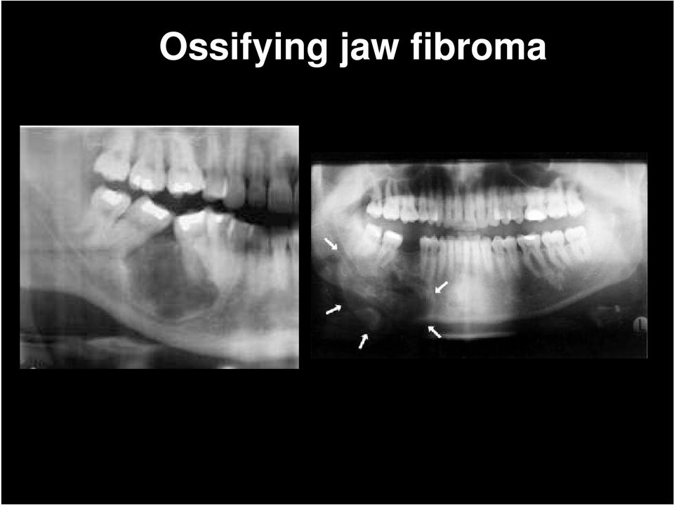 fibroma