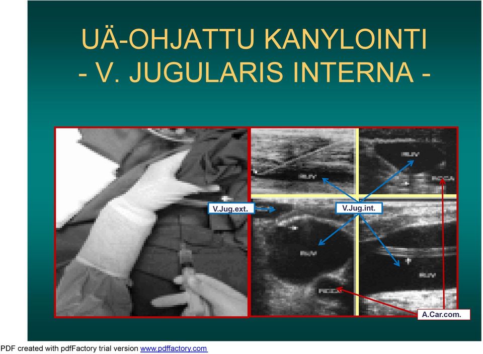 JUGULARIS INTERNA -