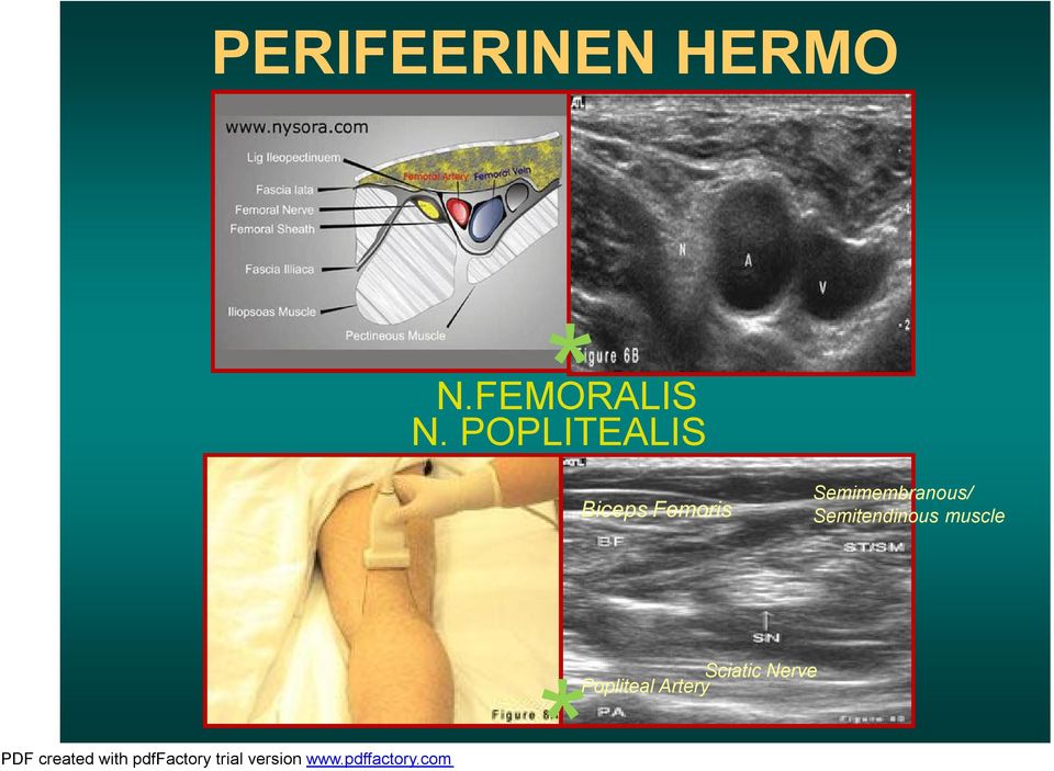 POPLITEALIS Biceps Femoris