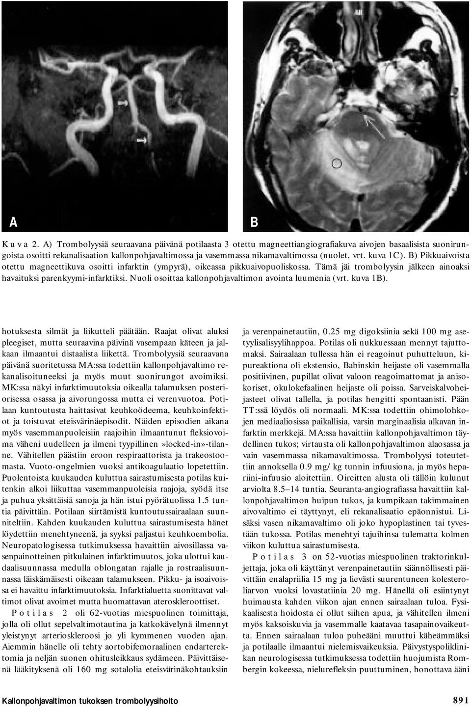 (nuolet, vrt. kuva 1C). B) Pikkuaivoista otettu magneettikuva osoitti infarktin (ympyrä), oikeassa pikkuaivopuoliskossa. Tämä jäi trombolyysin jälkeen ainoaksi havaituksi parenkyymi-infarktiksi.