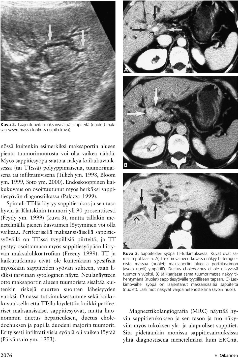 Endoskooppinen kaikukuvaus on osoittautunut myös herkäksi sappitiesyövän diagnostiikassa (Palazzo 1999).