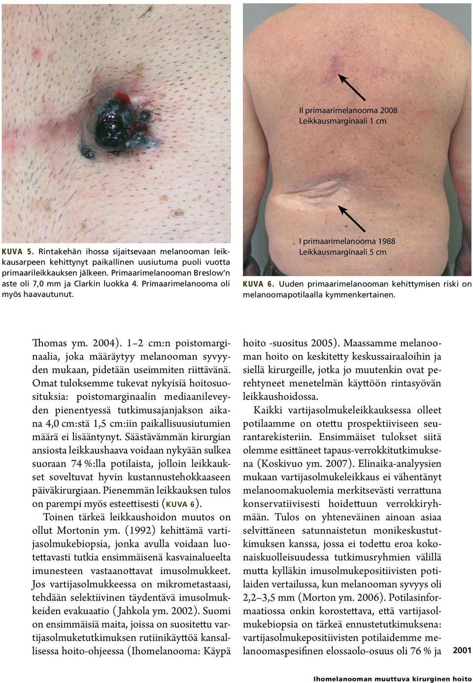 Uuden primaarimelanooman kehittymisen riski on melanoomapotilaalla kymmenkertainen. Thomas ym. 2004).