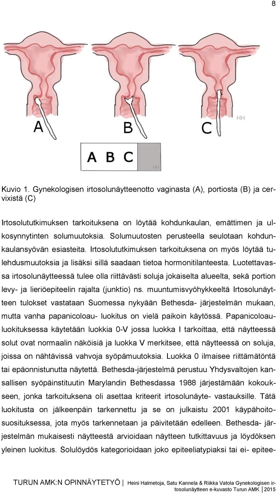 Luotettavassa irtosolunäytteessä tulee olla riittävästi soluja jokaiselta alueelta, sekä portion levy- ja lieriöepiteelin rajalta (junktio) ns.