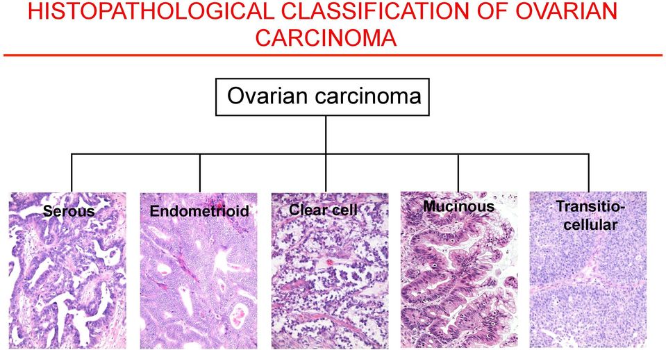 carcinoma Serous Endometrioid