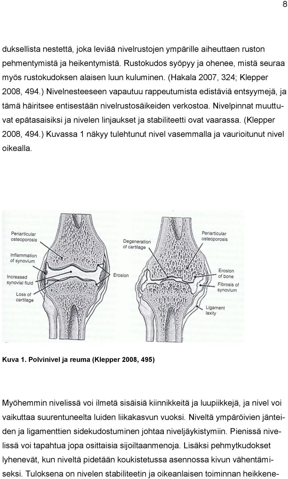 Nivelpinnat muuttuvat epätasaisiksi ja nivelen linjaukset ja stabiliteetti ovat vaarassa. (Klepper 2008, 494.) Kuvassa 1 näkyy tulehtunut nivel vasemmalla ja vaurioitunut nivel oikealla. Kuva 1.