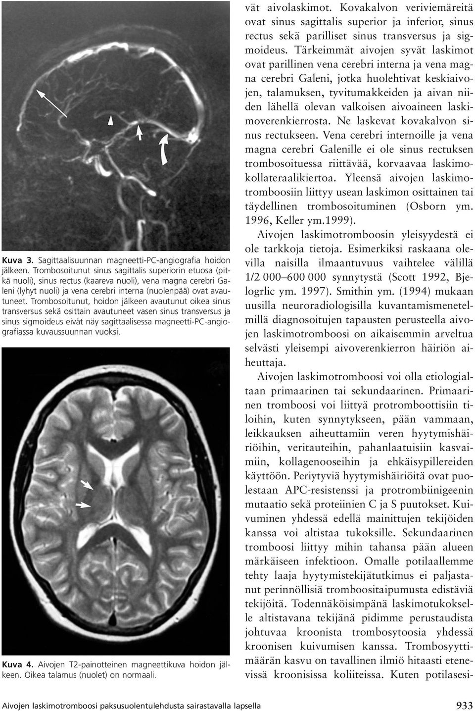 Trombosoitunut, hoidon jälkeen avautunut oikea sinus transversus sekä osittain avautuneet vasen sinus transversus ja sinus sigmoideus eivät näy sagittaalisessa magneetti-pc-angiografiassa