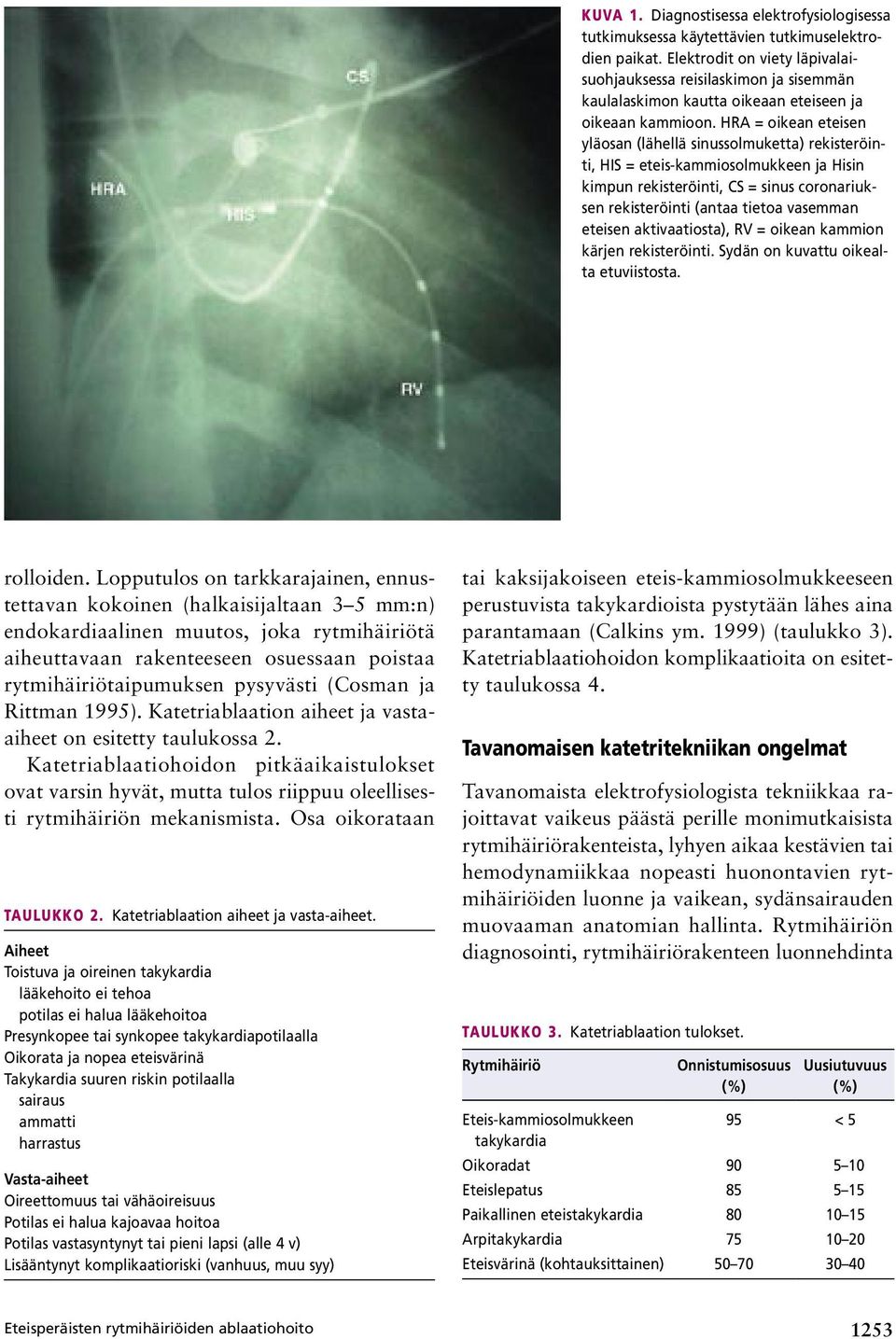 HRA = oikean eteisen yläosan (lähellä sinussolmuketta) rekisteröinti, HIS = eteis-kammiosolmukkeen ja Hisin kimpun rekisteröinti, CS = sinus coronariuksen rekisteröinti (antaa tietoa vasemman eteisen